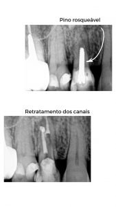 Tratamento de Canal com Microscópio em Belo Horizonte