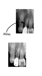 Tratamento de Canal com Microscópio em Belo Horizonte