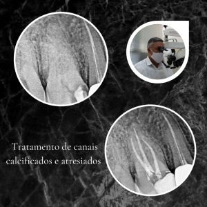 Tratamento de Canal com Microscópio em Belo Horizonte