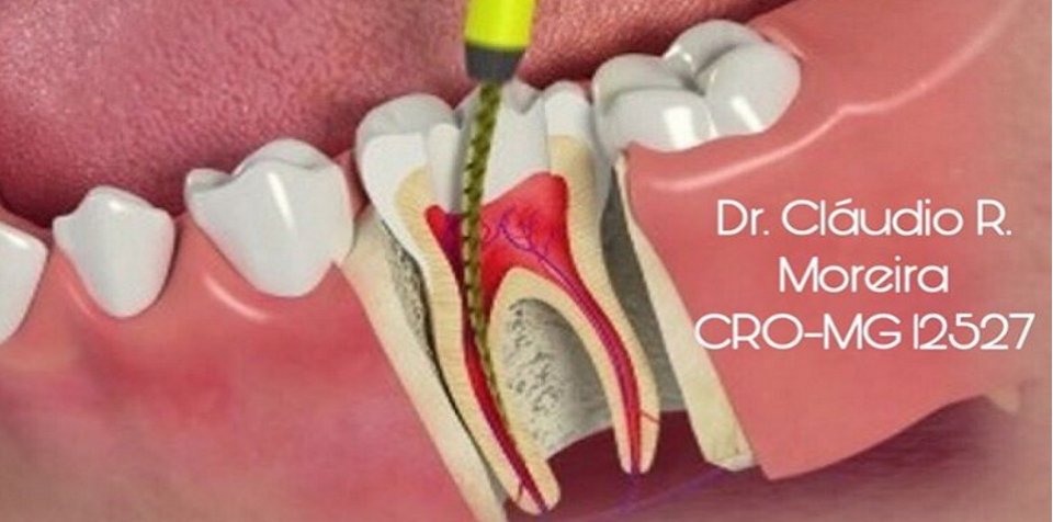 O que é Endodontia
