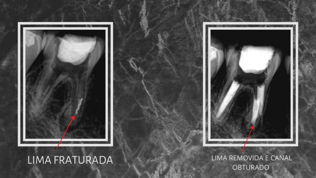 Remoçao de Lima fraturada