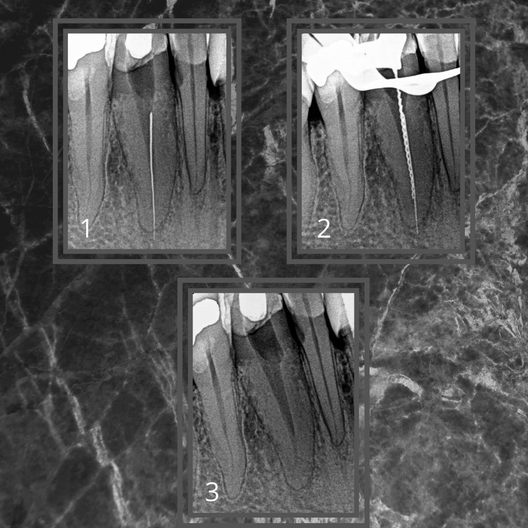 Remoção Lima fraturada que ultrapassou o forame apical