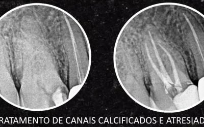 O que é um Canal Calcificado