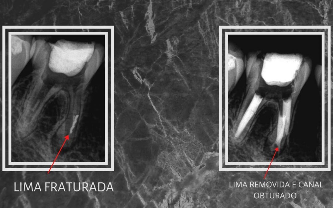 Remoção de Lima Fraturada