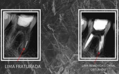 Remoção de Lima Fraturada