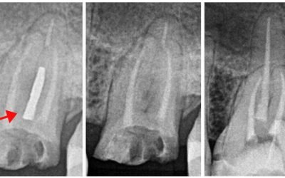 Remoção de Pinos Intrarradiculares em Dentes Tratados de Canal