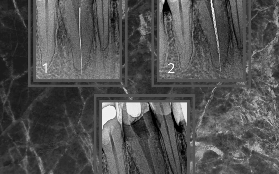 Lima Fraturada que ultrapassou o forame Apical