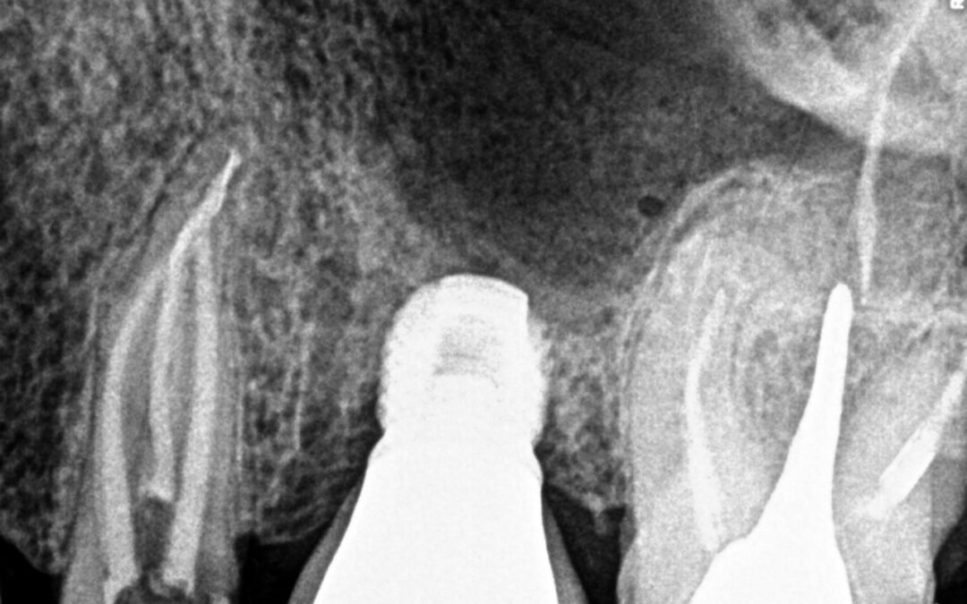 Dente com variação anatômica