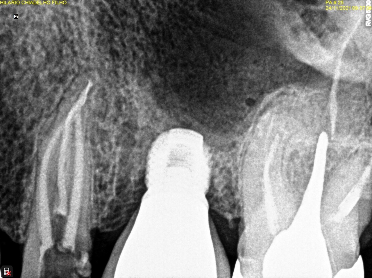 Tratamento de Canal com Microscópio em Belo Horizonte