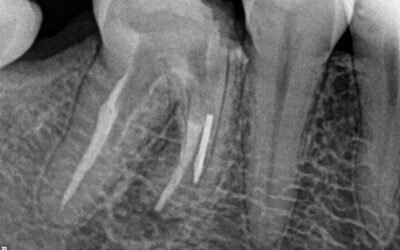Remoção de broca gates fraturada dentro do canal