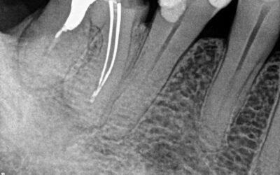 Remoção de Cones de Prata