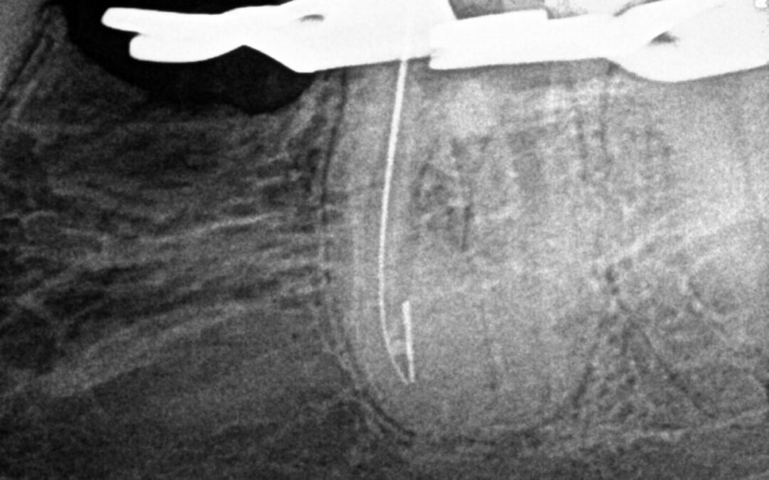 Remoção de Lima fraturada