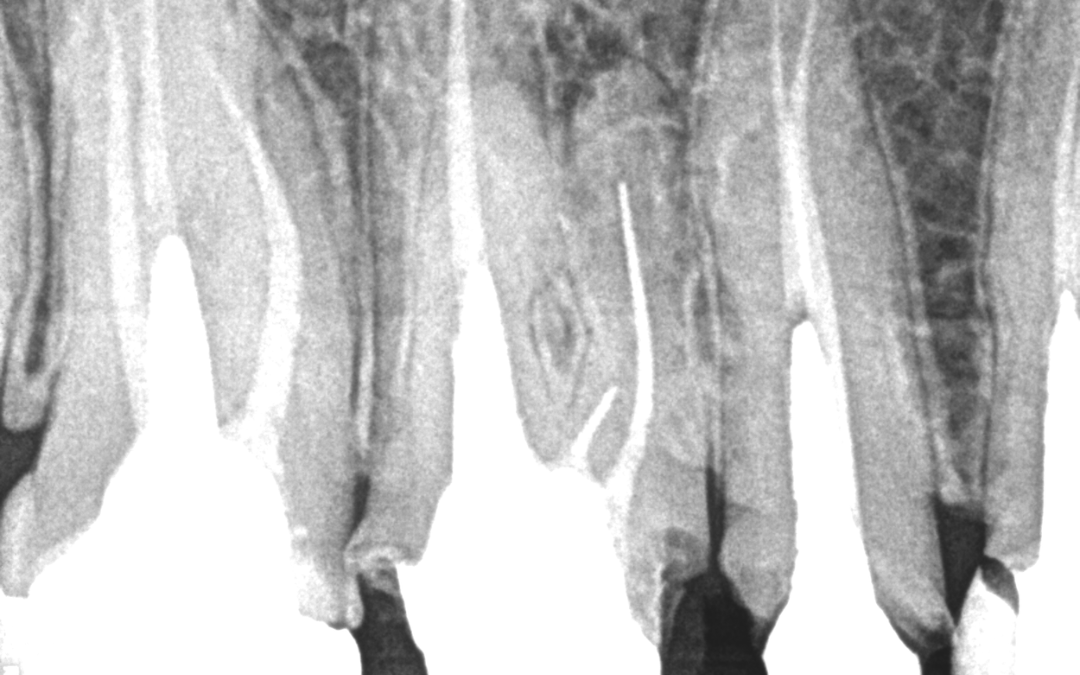 Remoção de limas fraturadas com pontas de ultrassom