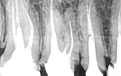 Remoção de limas fraturadas com pontas de ultrassom